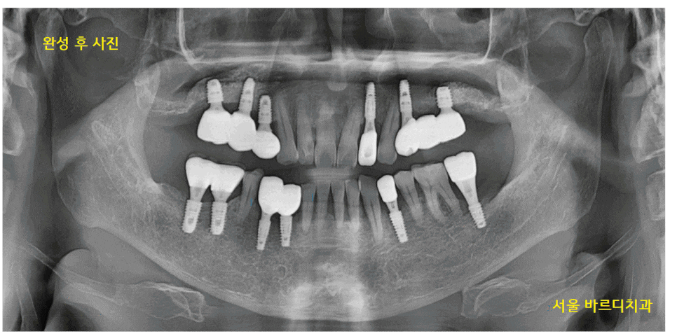 하남시청치과 디지털 임플란트를 고집하는 이유 관련 이미지 1