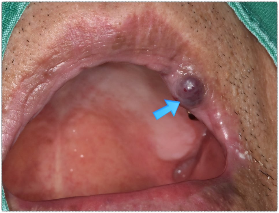 입술에 검은 점이 생겼는데 없앨 수 있나요? 입술 정맥호 혈관종 제거 관련 이미지 1