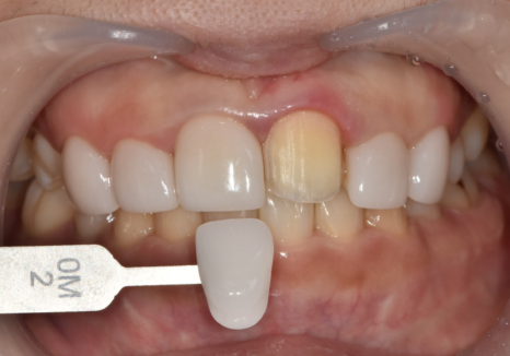 천호 라미네이트 파절 탈락, 줄이려면 치과 선택이 중요합니다. 관련 이미지 10