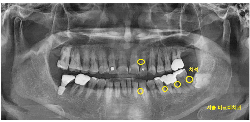 상일동역 스케일링 치과 잇몸치료 받아야하는 이유 필독! 관련 이미지 1