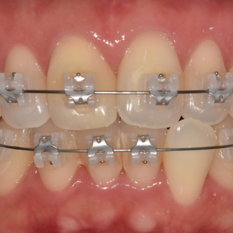 Can Protruding Mouth Be Corrected with Orthodontics Alone, Without Surgery? Sangil-dong Orthodontic Clinic image 4