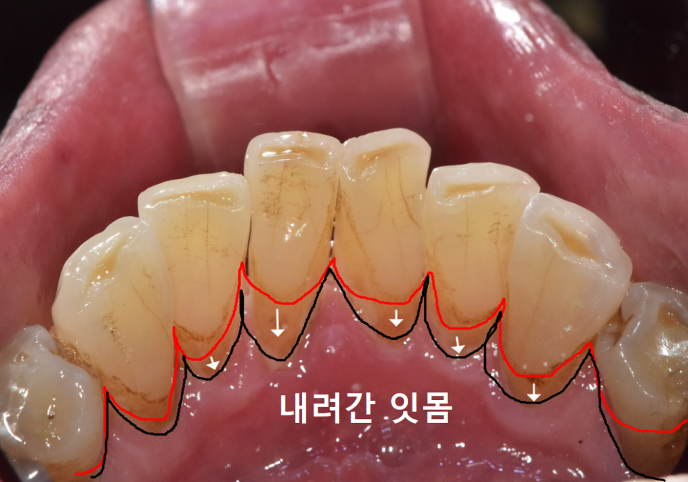 강동구 임플란트 가격 줄이는 방법 2개 발치했는데, 1개만 심어도 된다구요? 관련 이미지 3