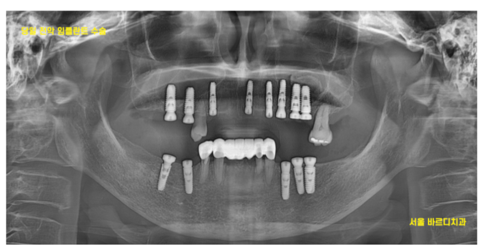 미사 치과 임플란트 후 식사는 어떻게? 운동은 해도 될까요? 술은... 관련 이미지 3