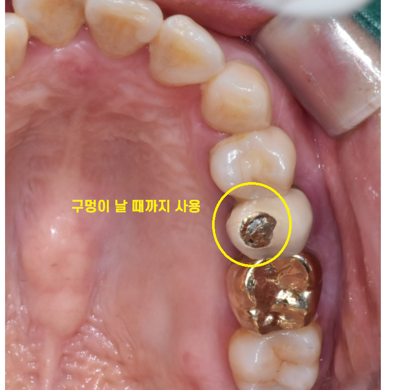 덕풍동 치과 씹을때 통증 임플란트로 극복했습니다. 관련 이미지 5