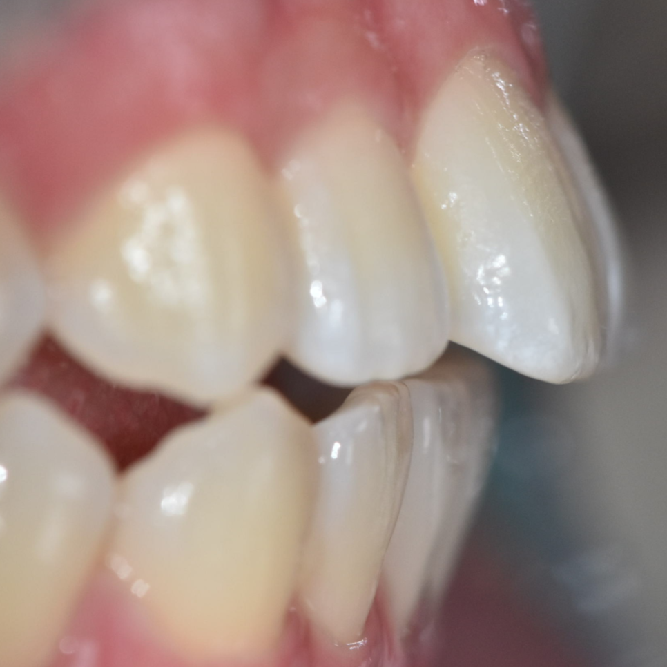 Can Protruding Mouth Be Corrected with Orthodontics Alone, Without Surgery? Sangil-dong Orthodontic Clinic image 10
