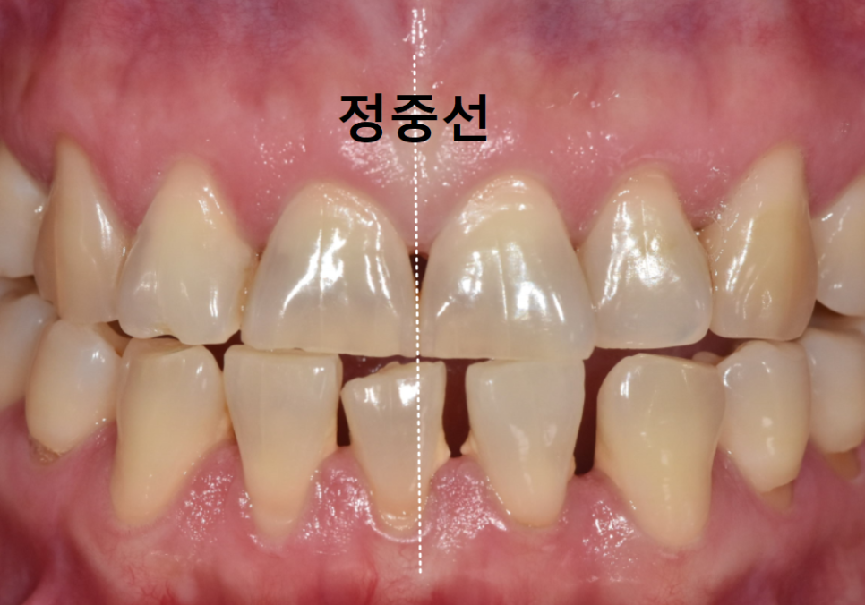 Spaces Between Front Teeth Due to Congenital Missing Teeth: Is Orthodontic Treatment the Only Answer? image 4