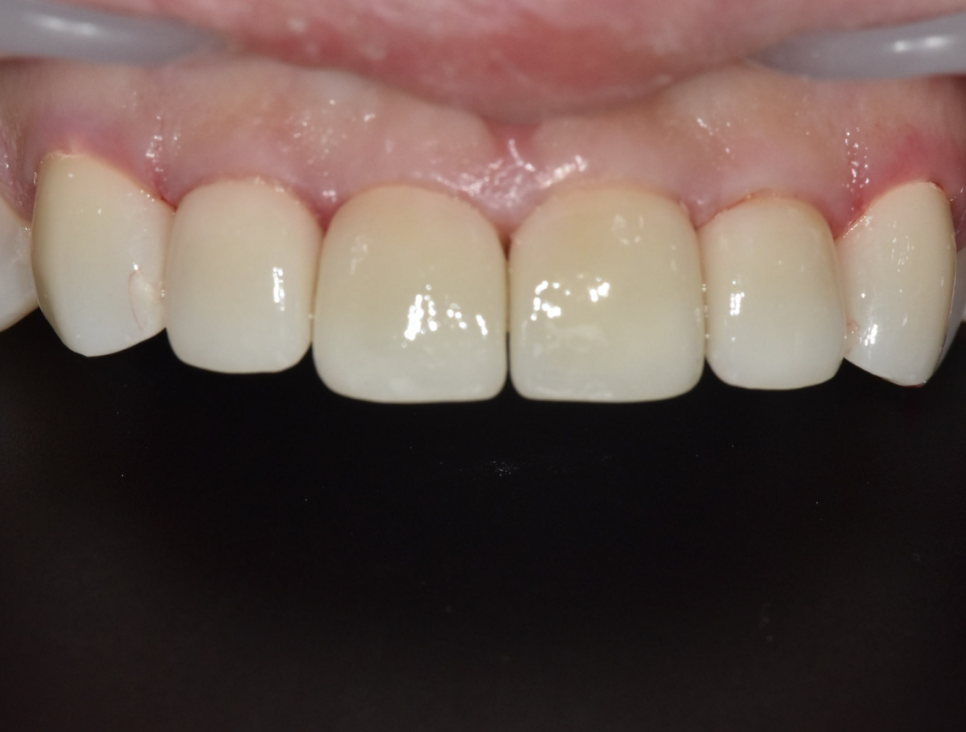 강동구 라미네이트, 치아 하얀 반점 없애고 싶다면? 치료 방법 관련 이미지 12