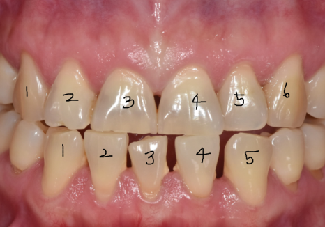 Spaces Between Front Teeth Due to Congenital Missing Teeth: Is Orthodontic Treatment the Only Answer? image 2