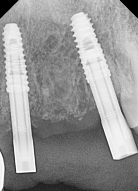 오래된 앞니 크라운 냄새, 관련 이미지 10