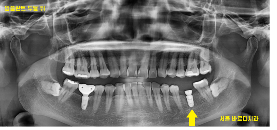 풍산동 치과 아래 어금니 임플란트 뼈 이식 없이 해결했습니다. 관련 이미지 7