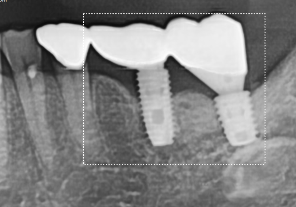 천호동 임플란트 재식립 사례, 평생 쓰는 줄 알았는데? 관련 이미지 13