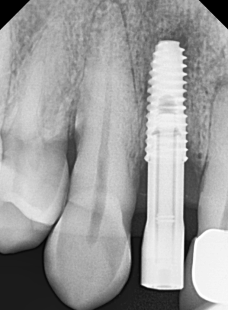 앞니 임플란트, 원내 기공소의 중요성을 아시나요? 관련 이미지 9