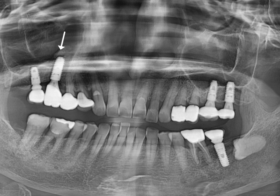 잇몸 고름 눌러보니 푹... 임플란트 주위염 방치했다가 재수술한 사례 관련 이미지 18