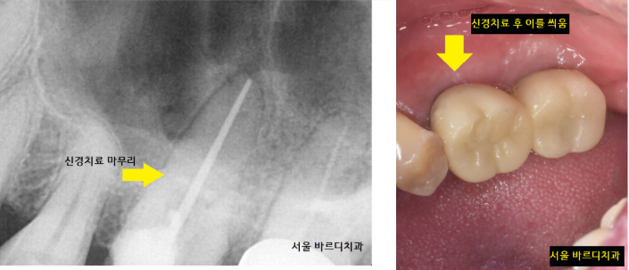 상일동치과 비가역적 치수염 치아 심폐소생했습니다. 관련 이미지 6