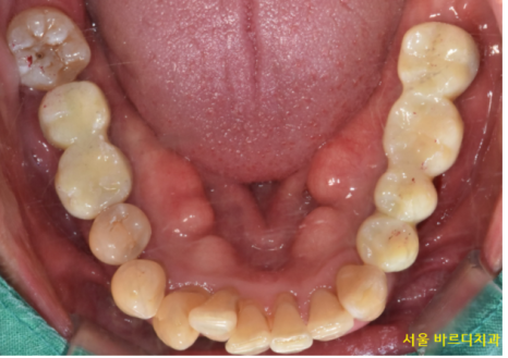 길동 치과 임플란트 뼈이식 후 흡연 상관 있을까? 관련 이미지 12