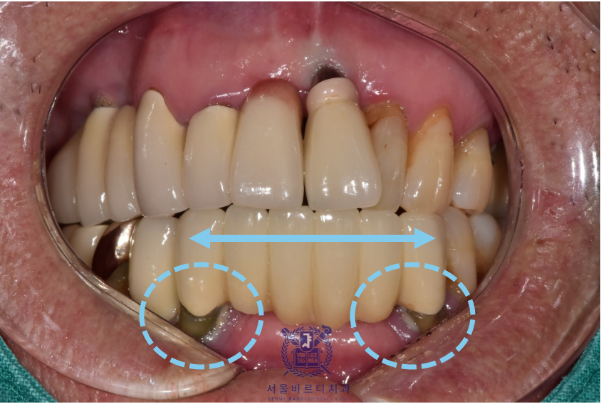 고덕동치과 서울바르디치과 전치부 및 구치부 임플란트 치료증례 #10 관련 이미지 3