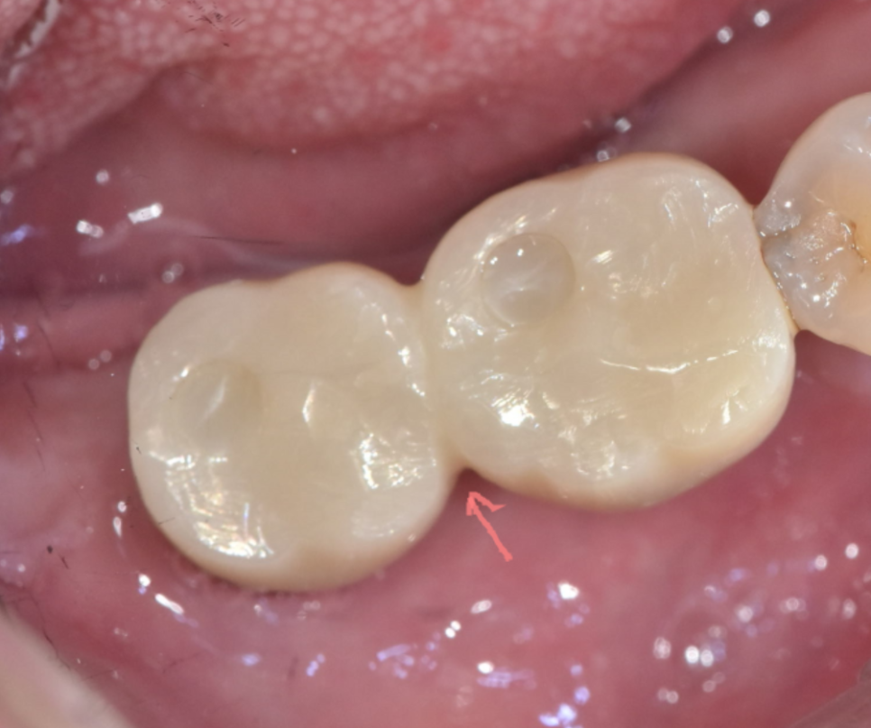 고덕동치과 임플란트 악취 냄새가 나는 이유는? 관련 이미지 3