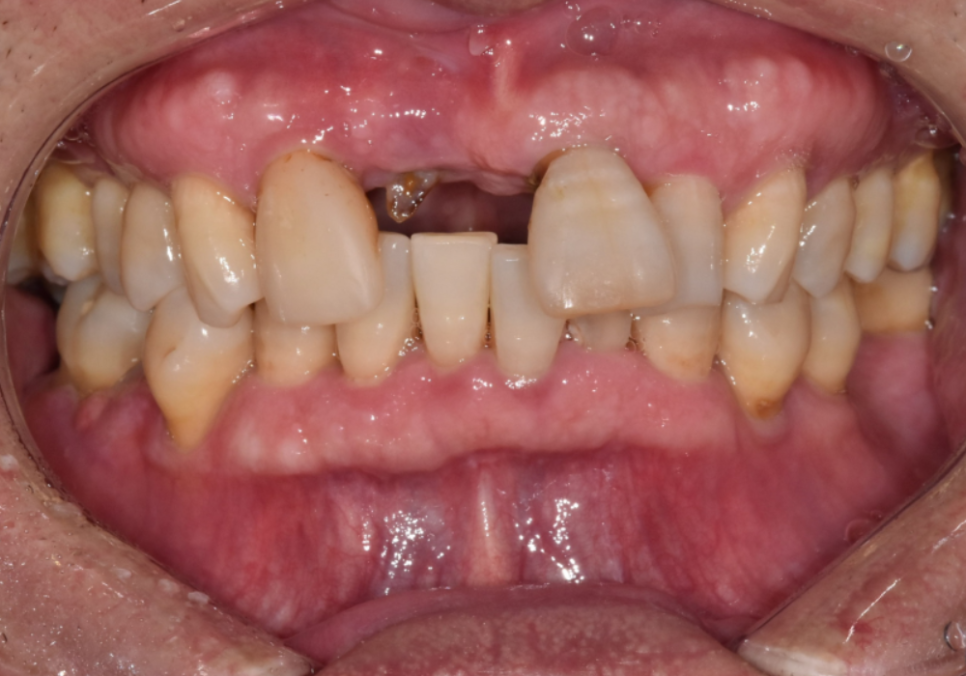 대문니 빠짐, 앞니 빠졌을 때 브릿지와 임플란트 중 나에게 맞는 선택은? 관련 이미지 3