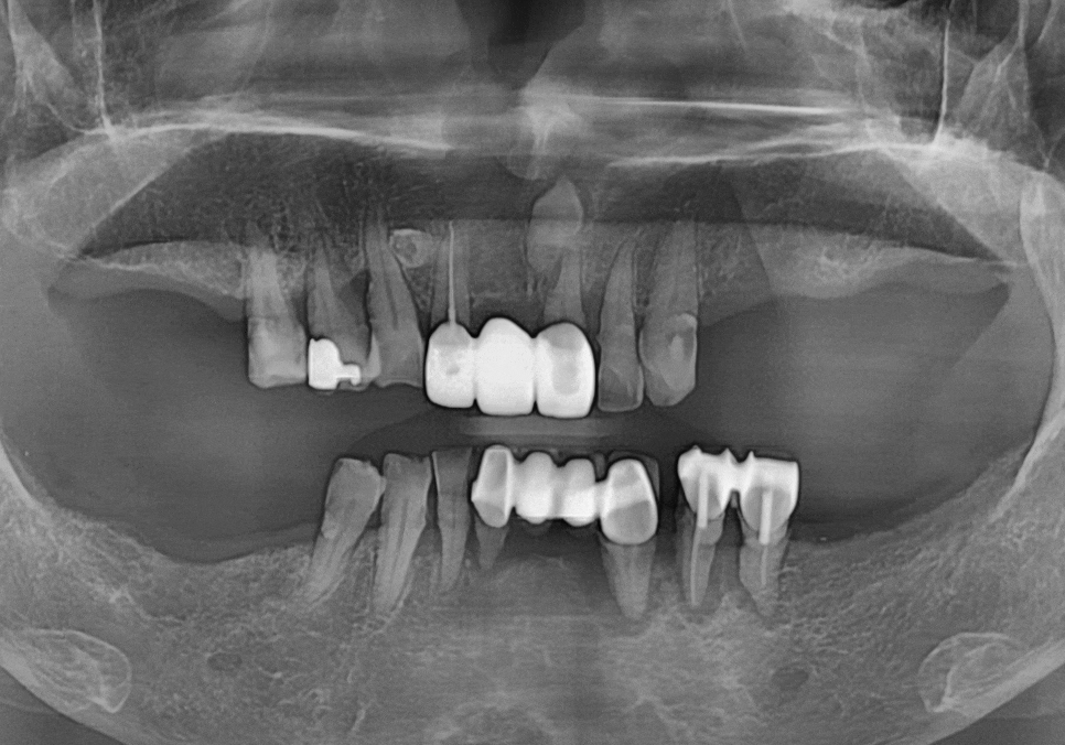 천호 디지털 가이드 임플란트, 일반 임플란트와 무슨 차이가 있나요? 관련 이미지 15