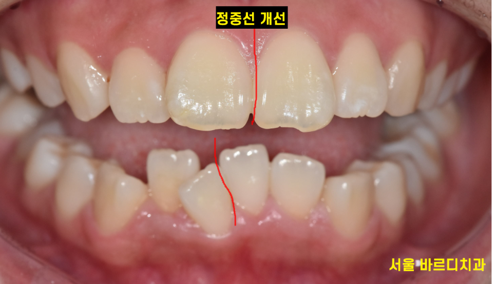 투명교정 치료 과정 이렇게 진행됩니다! 집에서 장치를 받아요! 관련 이미지 1