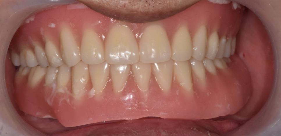 고덕역  치과 틀니쓰다 위아래 전악 임플란트 재건했습니다. 관련 이미지 8