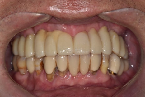 얇은 잇몸뼈, 임플란트 거부 당했다면? 상악동거상술로 해결할 수 있습니다. 관련 이미지 15