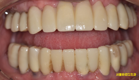 고덕역  치과 틀니쓰다 위아래 전악 임플란트 재건했습니다. 관련 이미지 13