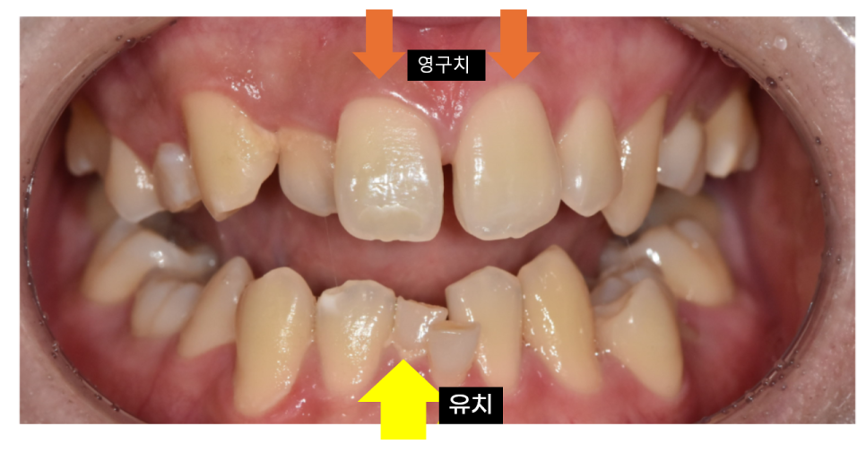 고덕 소아교정 아이 성장기를 이용한 단 한 번의 기회! 관련 이미지 6