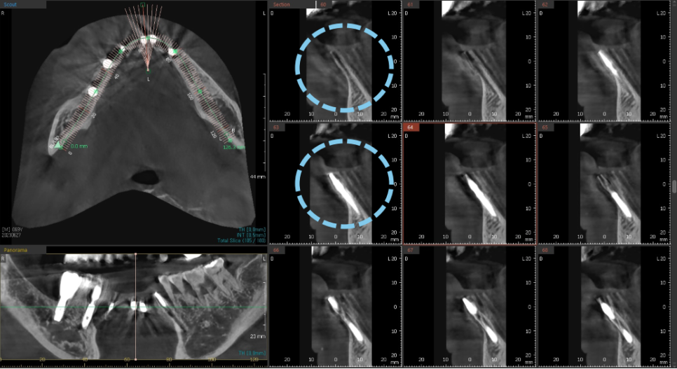고덕동치과 서울바르디치과 전치부 및 구치부 임플란트 치료증례 #10 관련 이미지 8