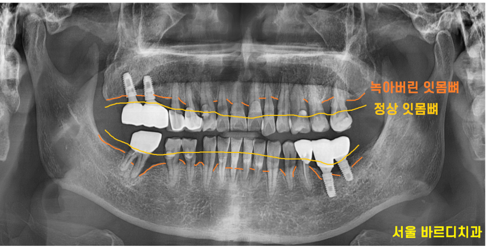 녹아버린 잇몸뼈 흔들리는 여러 치아 발치 후 임플란트 시행 관련 이미지 2