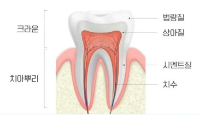 치아 교정 중 치간 삭제 치아를 깎는다고요??? 관련 이미지 2
