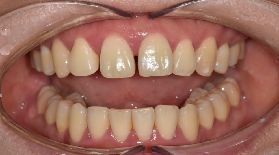 Two Types of Retainers Are Needed After Orthodontic Treatment: Bonded and Removable image 7