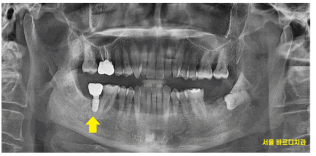 하남시청치과 내비게이션 임플란트 왜 좋다는거죠? 관련 이미지 1