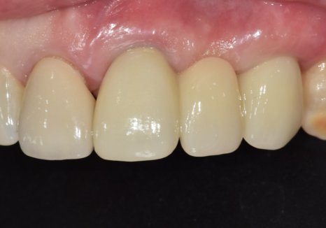 오래된 앞니 크라운 냄새, 관련 이미지 13