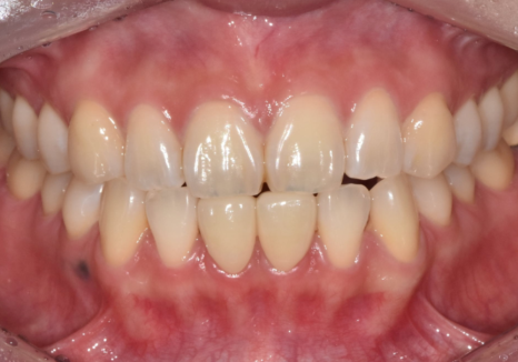 앞니 라미네이트, 치아 시림 고민 덜 수 있는 해결 방법 공개합니다. 관련 이미지 13