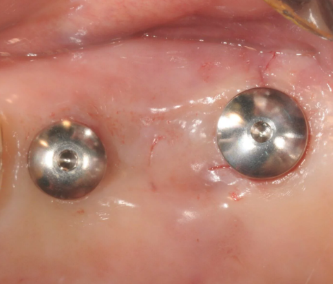 고덕동 임플란트 통증 걱정으로 수술 엄두가 안나시는 분들께 관련 이미지 2