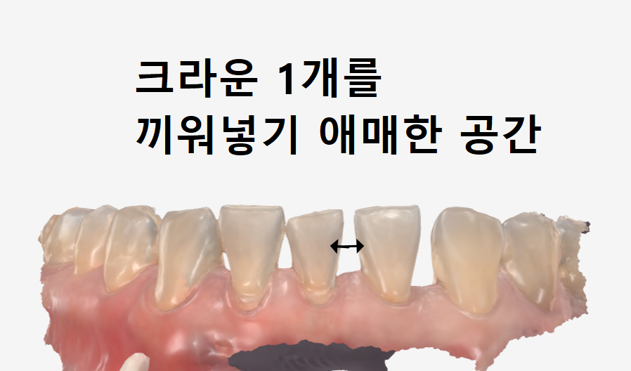 Spaces Between Front Teeth Due to Congenital Missing Teeth: Is Orthodontic Treatment the Only Answer? image 6