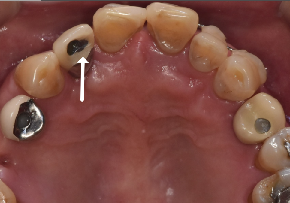 앞니 흔들림, 임플란트 치아보험 감액 기간 넘기려다 더 큰 손해 봅니다. 관련 이미지 8