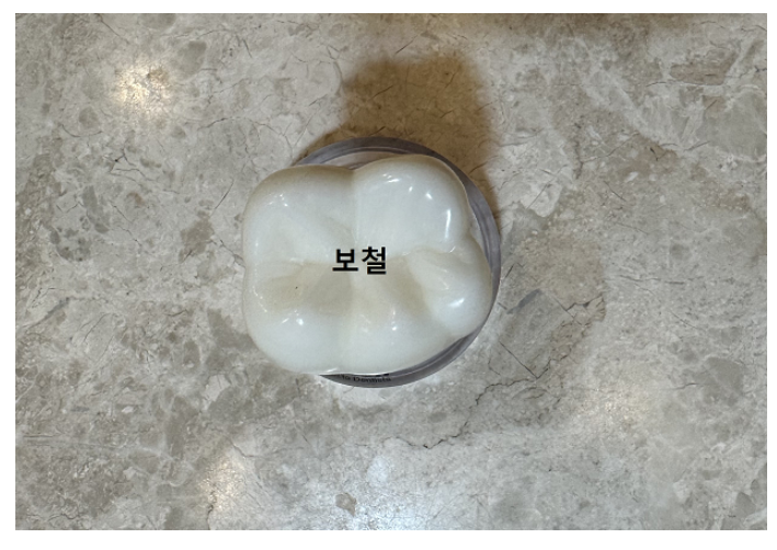 임플란트 관리 도대체 어떻게 해야 하는 건가요?? 관련 이미지 1