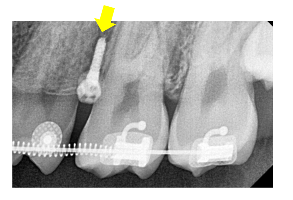Answering Your Questions About Orthodontic Mini-Screw Placement. (Q&A) image 2