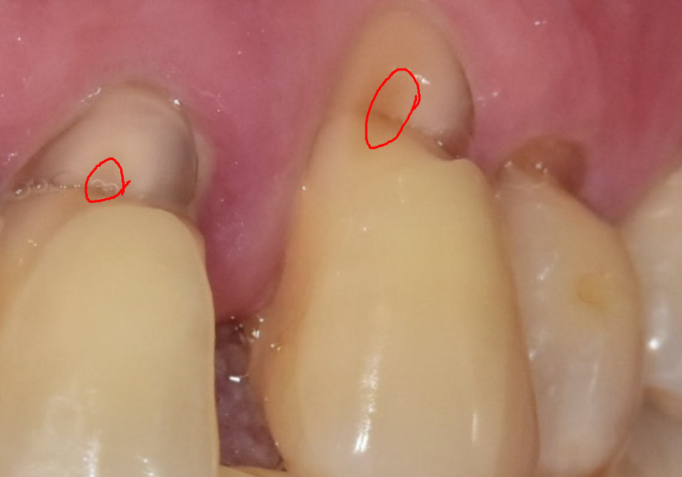 치아 시림 증상 때문에 고민이신가요? 그렇다면 양치질 너무 열심히 하지 마세요. 관련 이미지 9