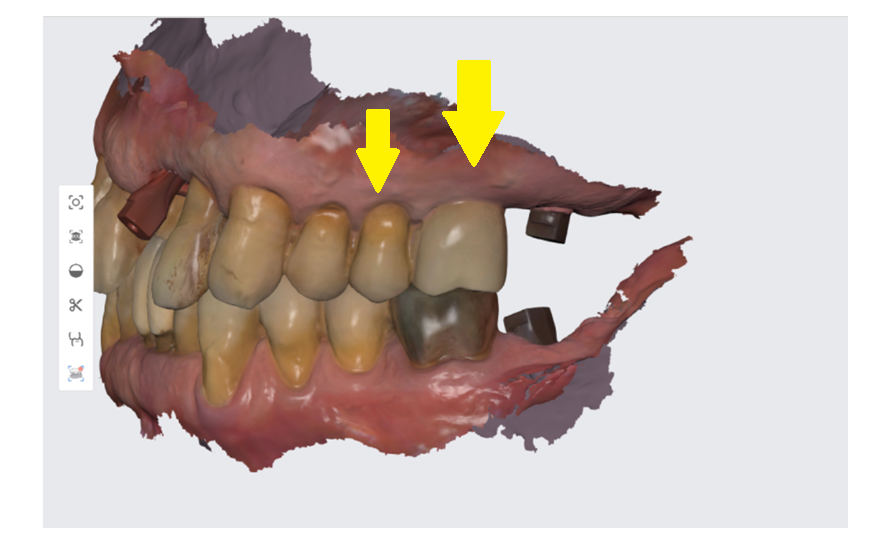맨 끝 어금니 임플란트 먼저 무너지는 이유가 있습니다. 관련 이미지 3