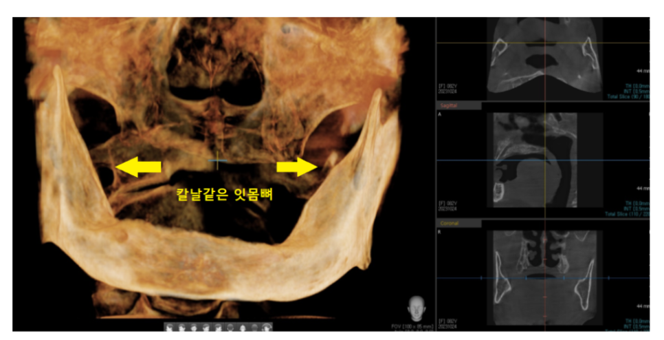 올온포 치아가 다 없어도 임플란트 4개만으로 복원이 가능합니다 관련 이미지 2