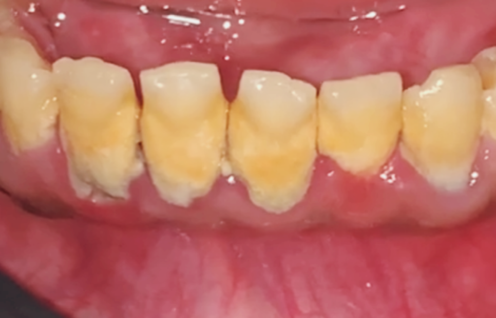 고덕동 스케일링 미루다 앞니 어금니 다 뽑고 임플란트 했습니다. 관련 이미지 1
