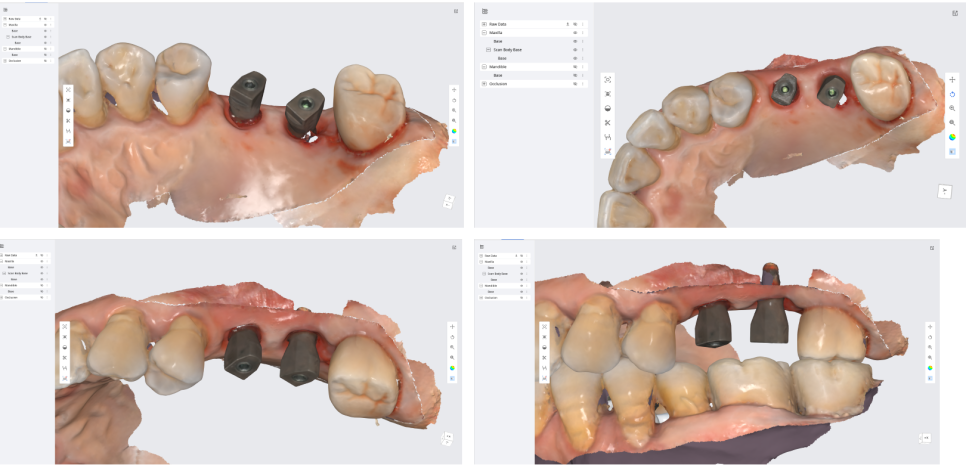 고덕동치과 서울바르디치과 무절개 네비게이션 임플란트 치료증례 #2 관련 이미지 17