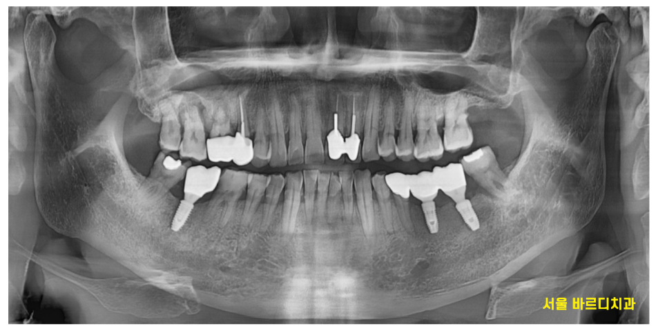 상일동 임플란트 치아 솟음으로 불편함을 느낄 때 관련 이미지 2