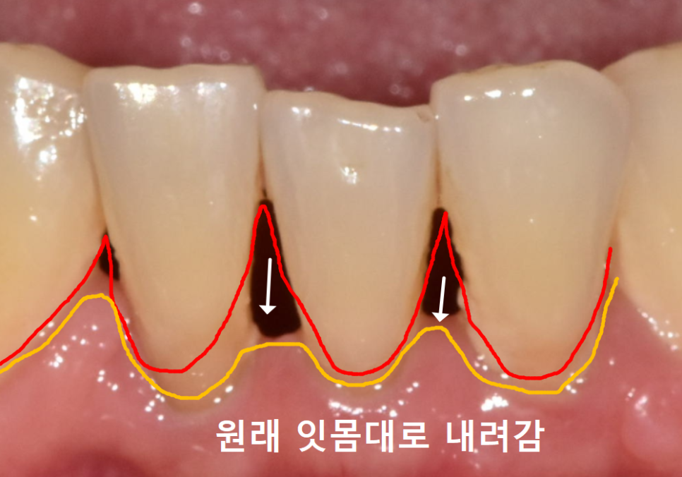 고덕동 어금니 사이 충치, 양치질 누구보다 열심히 하는데 왜 자꾸 생길까요? 관련 이미지 6