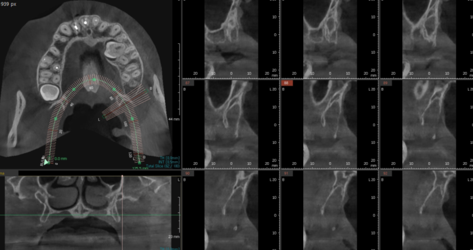 덕풍동 치과 교정 치료 위해 숨어있는 매복치 수술 발치 문제없습니다 관련 이미지 5