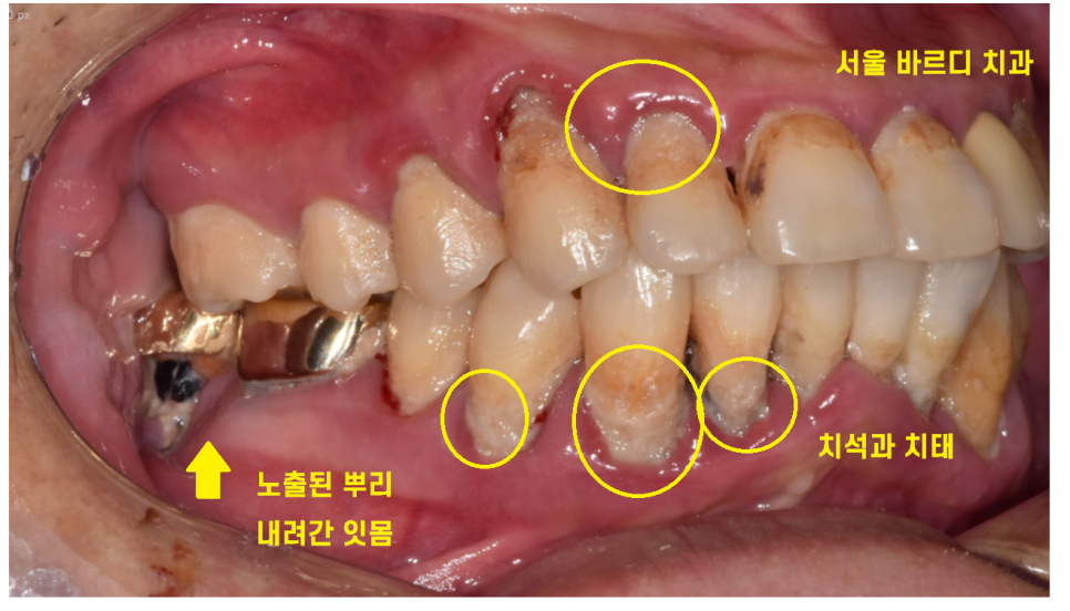 이 흔들림으로 발치 후 뼈이식 진행한 케이스 관련 이미지 3