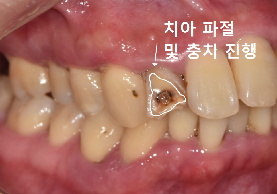 강동구 앞니 충치, 누구는 레진이고 누구는 임플란트인 관련 이미지 2